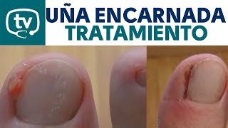 El tratamiento de la uña encarnada (¡Incluye imágenes!)