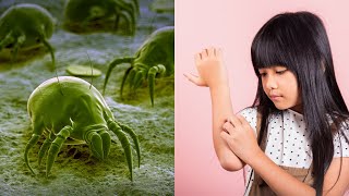 How To Get Rid of Scabies | Causes & Remedies
