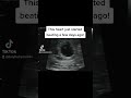 Brand New HeartBeat at 6 Weeks 1 Day Pregnant!