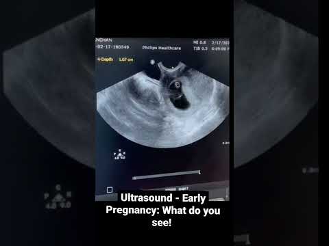Ultrasound in early pregnancy: What do you see!