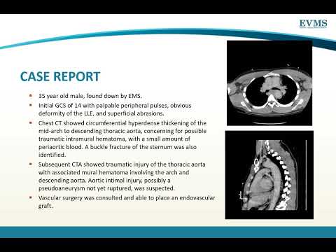 Thumbnail image of video presentation for Acute Aortic Injury: Signs and Symptoms and subsequent grading
