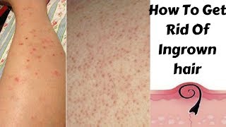 How To Get Rid Of Red Dots On Legs After Waxing