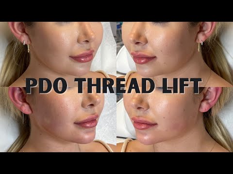 PDO Thread Lift Experience