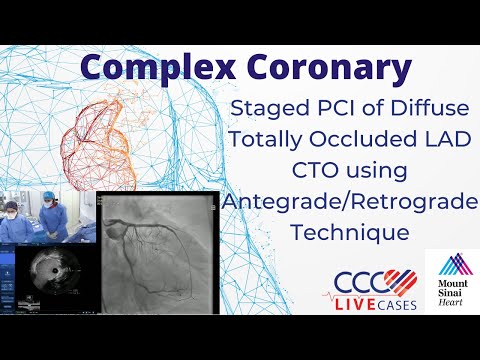 Staged PCI of Diffuse Totally Occluded LAD CTO using Antegrade/Retrograde Technique