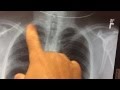 pneumonia on xray - YouTube