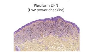 Deep Penetrating Nevus: morphological clues in the #NonAIpath program