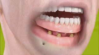 Straumann - Protesi removibile con attacco ritentivo