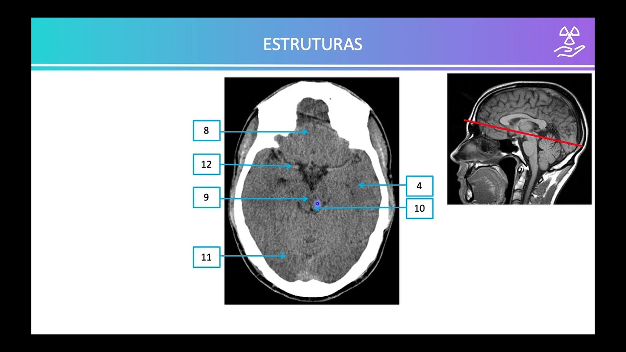 ANATOMIA SECCIONAL DO CRÂNIO - PARTES MOLES