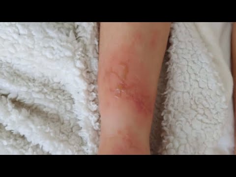 Djegia nga kandili ! Ndihma e pare per femijen tuaj !