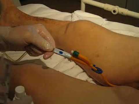 Hypertensive Krise und Komplikationen der Erste-Hilfe Jede Urtinktur von Blutdruck