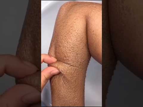 No More Dry Skin Naturally ✅ | Best Home Remedy 😱 #shorts #skincare