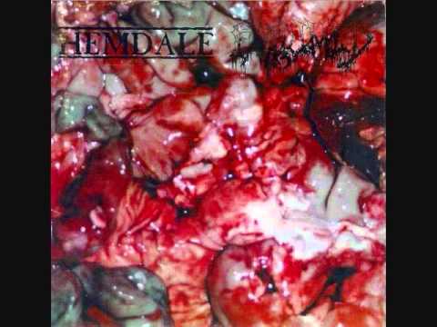 Exhumed - Dissecting the Caseated Omentum