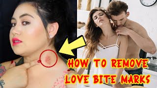 How to Remove Love Bite Marks Fast || Home Remedies for Love Bite Marks Removal