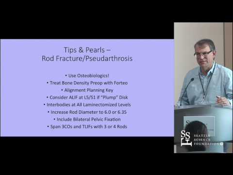 Avoidance & Management of Rod Fracture/Non-Unions in Patients by Robert Hart, MD