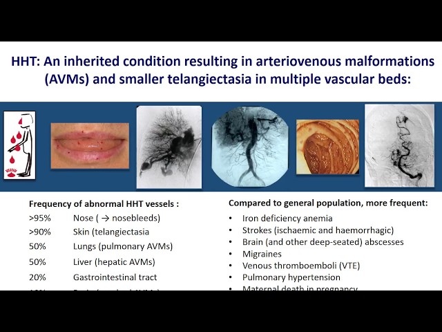 Video Pronunciation of telangiectasia in English