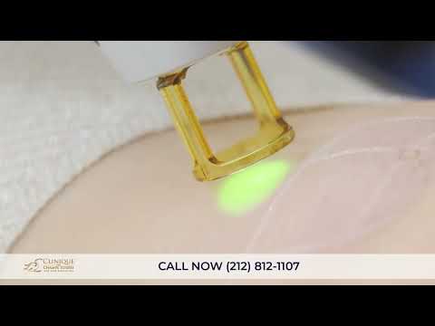 One Skin Resurfacing with HALO Fractional Laser Session at Clinique des Champs Élysées Medspa (Up to 60% Off) - Second Medium