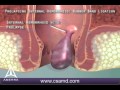 Rubber Band Ligation for Hemorrhoids - 3D Medical Animation