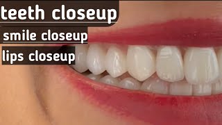 Download lagu Beautiful Smile Woman's Teeth with Veneers mp3