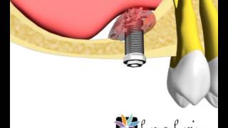 Atraumatic Sinus Lift