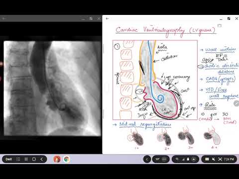 Cardiac Ventriculography (Left Ventriculogram)