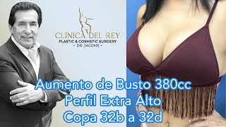 2 Meses - Aumento de Busto 380cc Perfil Extra Alto - Clínica del Rey - Dr. Franco Reyes Jácome