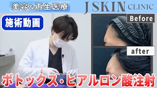 おでこのシワ改善|ボトックス・ヒアルロン酸【施術動画】