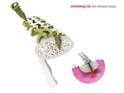 L1 Rib osteosynthesis system featuring CB3 technology