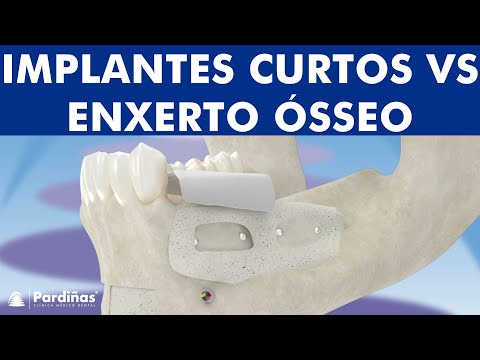Implantes curtos e enxerto ósseo ©