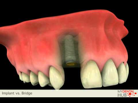 comment financer implants dentaires