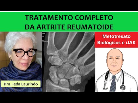 Os tratamentos para artrite reumatoide que funcionam com segurança.