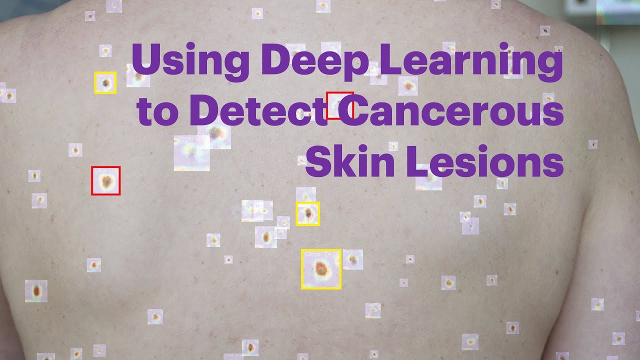 Using deep learning to detect cancerous skin lesions FINAL