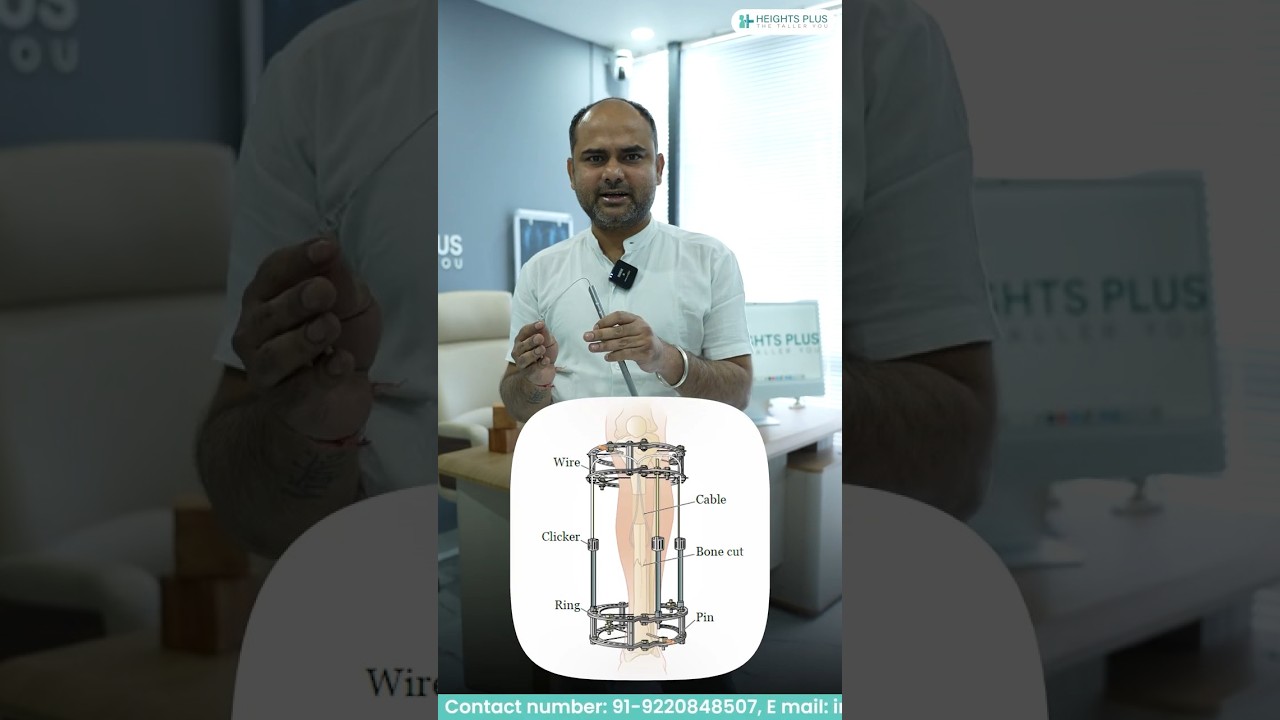Introducing Advanced Limb Lengthening Technology – FITBONE Internal Nail at Heights Plus