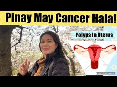 Polyps In Uterus Can Be Cancerous!