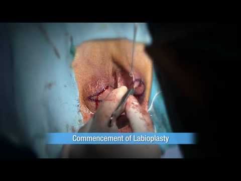 Labioplasty- Labia surgery 