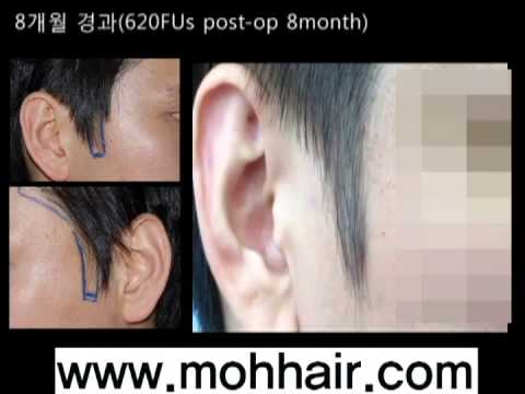 620FU's. Male Sideburns Hair Transplantation by Dr. Moh.