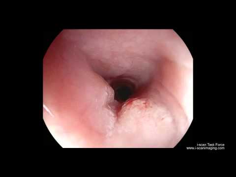 Cause of papilloma on uvula