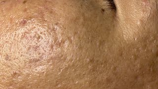Deep & Relaxing Acne Removal with Linh Mydang #576 P2