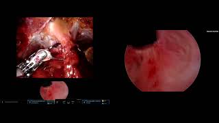Core Videos (2023): Robotic-Assisted Y-V Plasty of the Bladder Neck