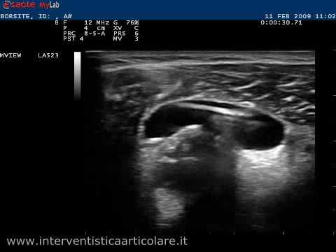 Larticolazione tibio-distale La rimozione di dolore acuto