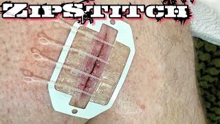 ZipStitch | World&#39;s Most Advanced Wound Closure Device!
