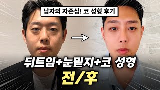 [리얼모델 VLOG] 퍼컬이 바뀔 만큼 밝아진 내 얼굴✨｜눈밑지방재배치, 뒷트임, 코 수술 1개월 리얼 후기???? #일퍼센트성형외과