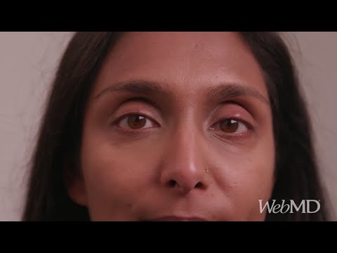 How to Treat a Stye | WebMD