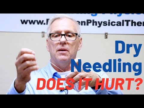 乾針是什麼？會痛嗎？是針灸嗎？ (What is Dry Needling? Does it Hurt? Is it Acupuncture?)