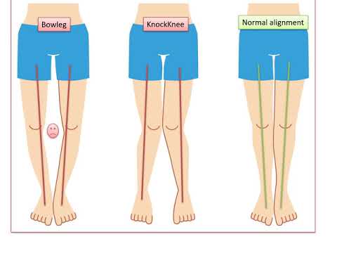 Image - Bowleg Treatment