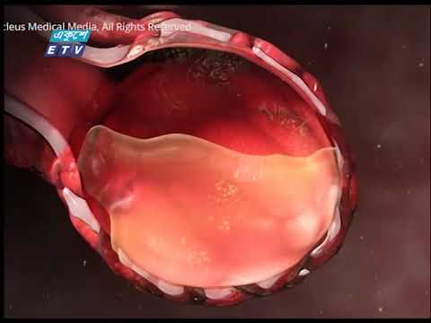 দ্বিতীয়বারও করোনা আক্রান্ত হতে পারে