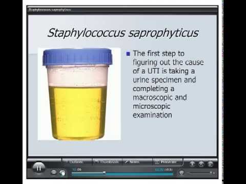calcificazioni prostata hematuria causes