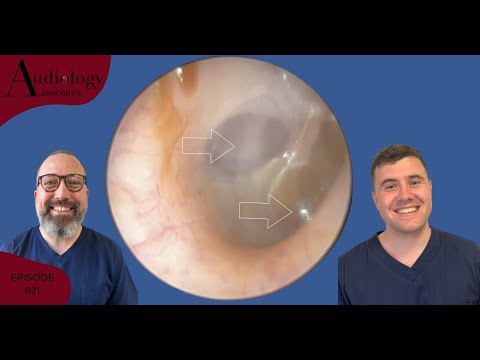 EAR WAX REMOVAL COMPILATION INC MIDDLE EAR EFFUSION- EP821