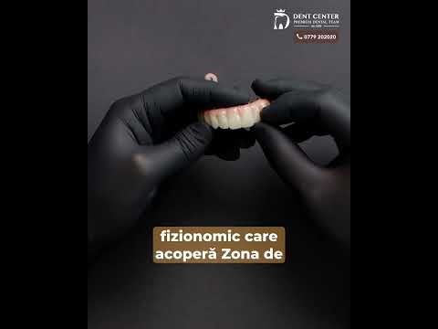 Din ce este compus implantul dentar?