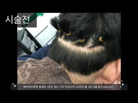 두피문신-절개,비절개 이식 흉터 한방 해결방법이???