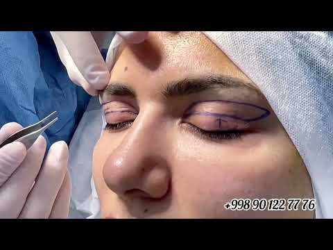 Dr. Choriyev — Blefaroplastika